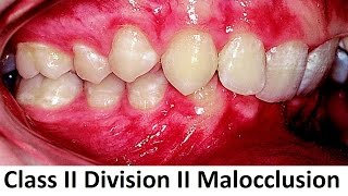 Can Class II Division II of Malocclusion Be Treated With Orthotropics by Prof John Mew [upl. by Asilim410]