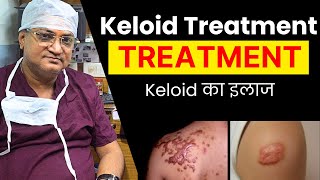 Keloid Removal Treatment  Keloid का इलाज  keloid scar  Dr Naren Pandey [upl. by Enaid]