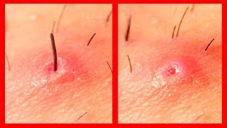 How To Get Rid Of Ingrown Hairs Naturally [upl. by Asante766]