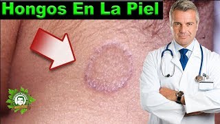 Aprende Como Eliminar Los Hongos De La Piel Combatelos Con Estos Remedios Que Me Funcionaron [upl. by Yhtimit]