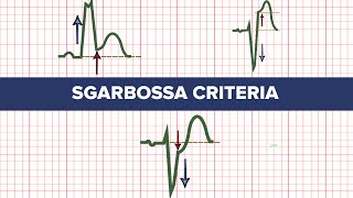 Sgarbossa Criteria  MEDZCOOL [upl. by Sumner]