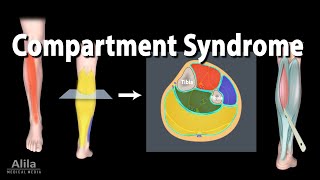 Compartment Syndrome Animation [upl. by Yeblehs]