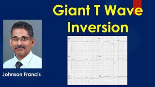 Giant T wave Inversion Deep T Inversion [upl. by Felisha]