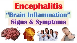 Encephalitis “Brain Inflammation” Signs and Symptoms amp Why They Occur [upl. by Suirauqed484]