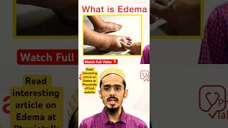 Edema क्या होता है  इसके Types क्या होते है  edema swelling shortsfeed [upl. by Ecirtnas]