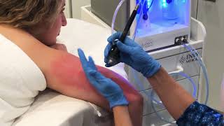 Dermalinfusion for KP Keratosis Pilaris [upl. by Filip]