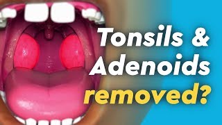 Tonsils and Adenoids Surgery [upl. by Giwdul]