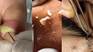 Unleashing Pimple Popper The Ultimate Satisfaction [upl. by Ynagoham]