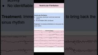 Ventricular Fibrillation [upl. by Sutton784]