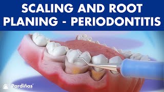 Treatment of periodontal disease  Scaling and root planing  Tartar © [upl. by Tremml]