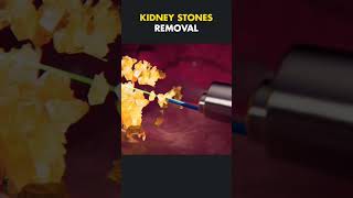 Kidney stone removal surgerypercutaneous nephrolithotomy PCNL [upl. by Johns801]