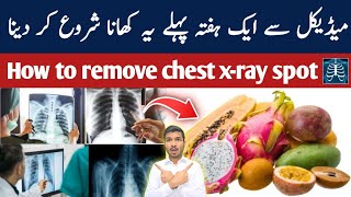 medical se ek hafta pehle ye khana shuru kar dena 🩻 chest xray spot problem [upl. by Raual140]