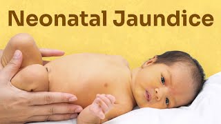 case presentation kse bnye neonatal jaundice prl how to make case presentation on neonatal jaundice [upl. by Lairret]