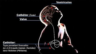 Lhydrocéphalie  partie 03 Traitement [upl. by Randall]
