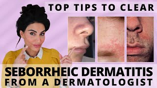 Top Tips to Clear Seborrheic Dermatitis  Dermatologist Deep Dive [upl. by Batsheva450]