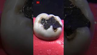 Restauración dental satisfying [upl. by Kabab731]