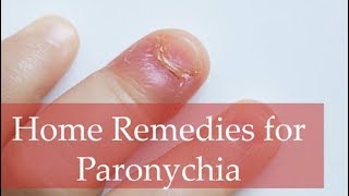 Top 6 Home Remedies for Paronychia and Best Home Treatment Methods [upl. by Touber]