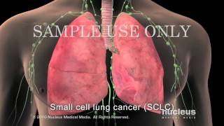 Small Cell Lung Cancer Staging [upl. by Balfour]