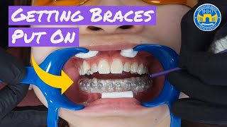 Process of Getting Braces [upl. by Lawlor]