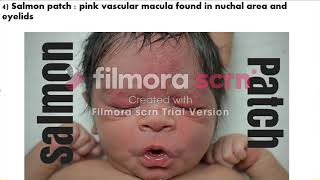 neonatal finding on physical examination [upl. by Airpac286]