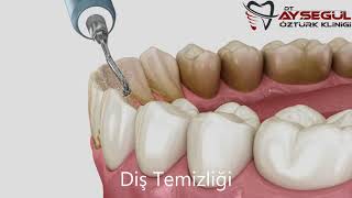 Diş Taşı Temizliği Profesyonel Diş Temizliği [upl. by Lramaj676]