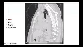 Discussion of fibrotic and nonfibrotic hypersensitivity pneumonitis cases English version [upl. by Kakalina]