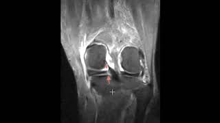 Medial meniscus root tear stress injury and joint effusion [upl. by Doro]