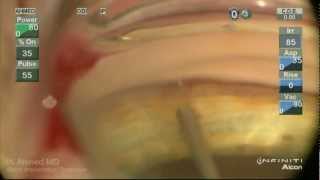 iStent Trabecular MicroBypass Implantation Ike Ahmed [upl. by Gifferd702]