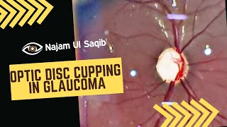 Optic Disc Cupping In Glaucoma Glaucomatous Optic Nerve Damage [upl. by Alaric]