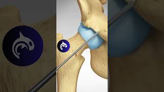 See how a Pincer Impingement of the Hip is repaired  3D Animation [upl. by Salahcin]