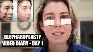 Blepharoplasty Video Diary  Day 1 After Surgery 1 of 15 [upl. by Amiarom541]