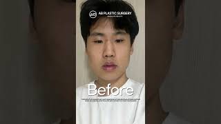 Plastic Surgery in Korea Protruded Mouth  Mandible Jaw  Hump Nose Review abplasticsurgery [upl. by Yeslaehc]