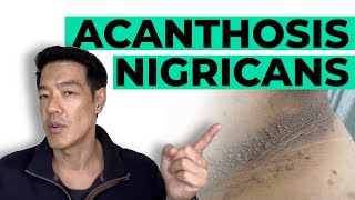 How to treat Acanthosis Nigricans  Dr Davin Lim [upl. by Raffaj]