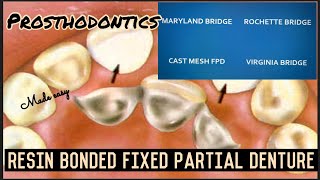 RESIN BONDED FIXED PARTIAL DENTURE II ROCHETTE MARYLAND CAST MESH VIRGINIA BRIDGES II FPD II easy [upl. by Pickens]