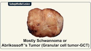 Mostly Schwannoma or Abrikossoff s Tumor Granular cell tumorGCT [upl. by Dahle]