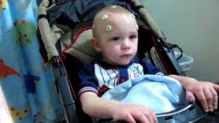 Infantile Spasms  Pre Brain Surgery [upl. by Jori]