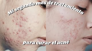 Dos meses de tratamiento para el acné  doxiciclina clindamicina y epiduo gel [upl. by Gorey]