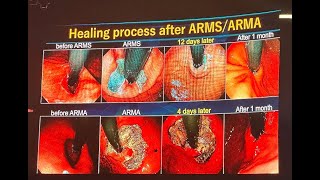 Anti Reflux Mucosal Ablation । ARMA ।Galaxy Hospital Nanded [upl. by Burnie382]