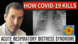 How Coronavirus Kills Acute Respiratory Distress Syndrome ARDS amp COVID 19 Treatment [upl. by Novyar]