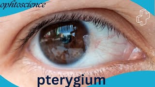 what is Pterygium Pterygium causes symptoms Treatment prevention [upl. by Reeva]