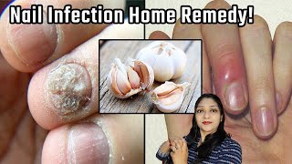 Nail fungus treatment\ nail infection treatment \ nakhun kharabho jaye to kya kare Anmol health [upl. by Boni]