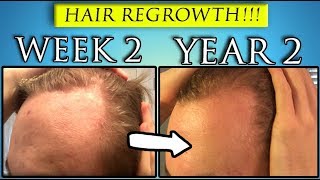 Coconut Oil  Castor Oil Hair Regrowth  YEAR 2 [upl. by Diba584]