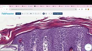 PITYRIASIS ROSEA Psoriasis clear cell acanthoma Lichen planus BLK LICHEN SCLEROSUS [upl. by Stinson]