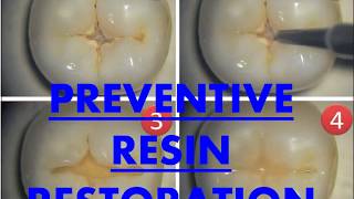 Preventive Resins Restorations I Dental Guide I Dr Bimal Chand I [upl. by Bourne]