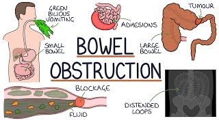 Understanding Bowel Obstruction [upl. by Eadwina]