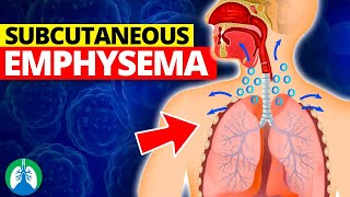 Subcutaneous Emphysema Medical Definition  Quick Explainer Video [upl. by Annaeiluj]