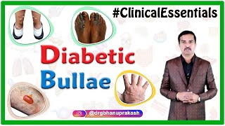 Diabetic bullae Bullosis Diabeticorum  Clinical essentials  Dr G Bhanu Prakash [upl. by Annoif846]