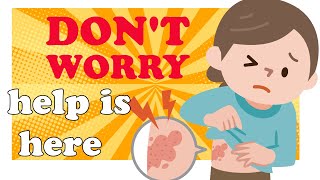 How to Care for a Child with Chickenpox [upl. by Wooster109]