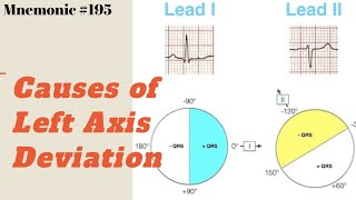 What are the Causes of Left Axis Deviation ECG  A simple Mnemonic to memorize all causes [upl. by Dnalwor290]