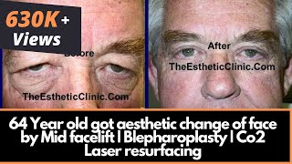 64 Year old got aesthetic change of face by Mid facelift  Blepharoplasty  Co2 Laser resurfacing [upl. by Aseena]